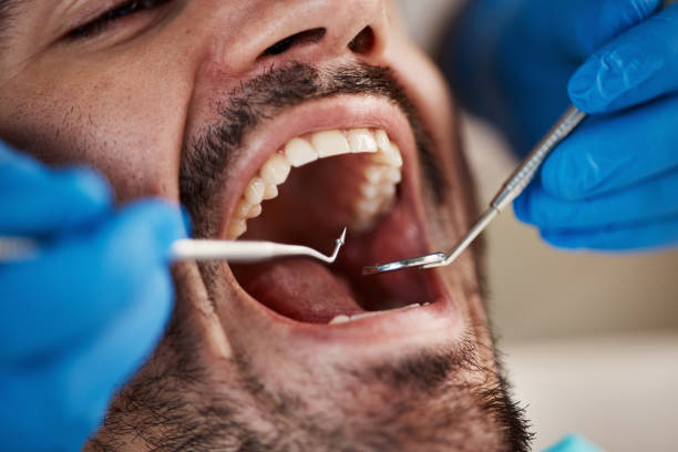 Best Emergency Tooth Extraction in Haysville, KS
